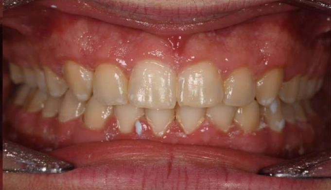 orthodontic case study overbite after