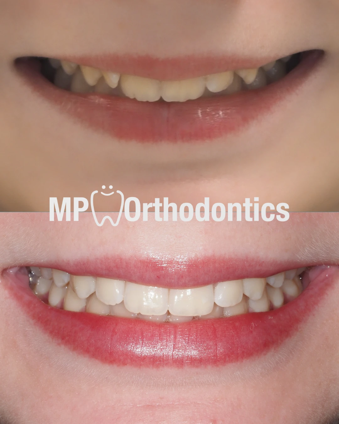 Before and After