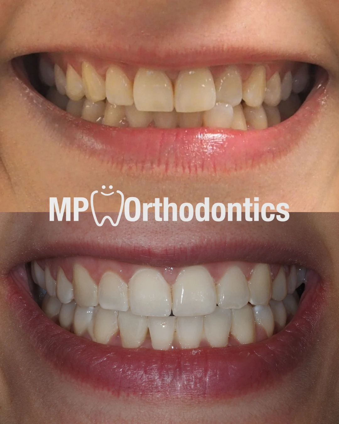 Before and After