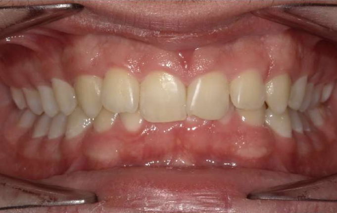 James' before braces photo - MP Orthodontics