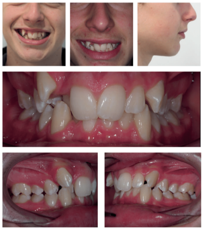 Luke's before braces photo - MP Orthodontics