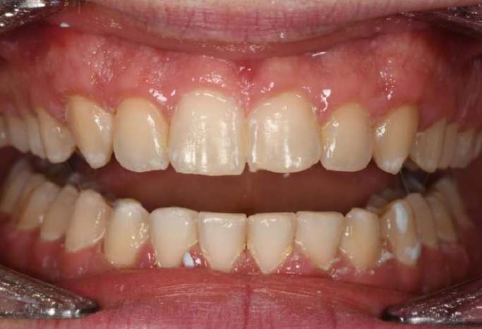 James' after braces photo - MP Orthodontics
