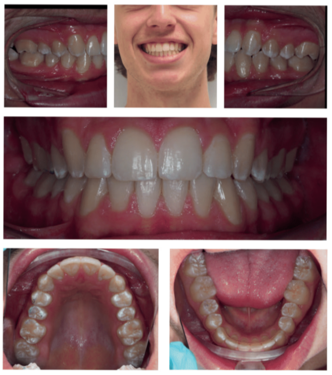 Luke's after braces photo - MP Orthodontics