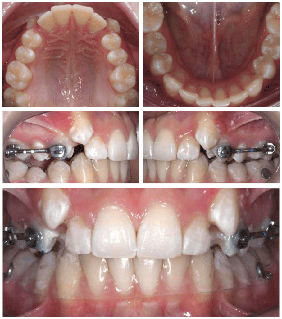 Jonathan's after braces photo - MP Orthodontics