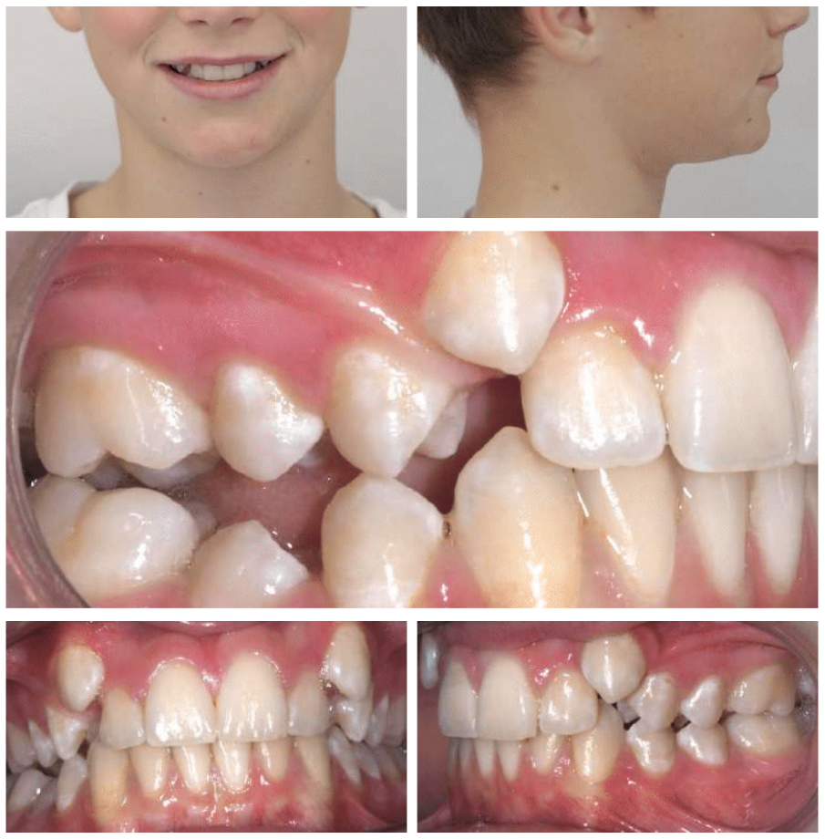 Jonathan's before braces photo - MP Orthodontics