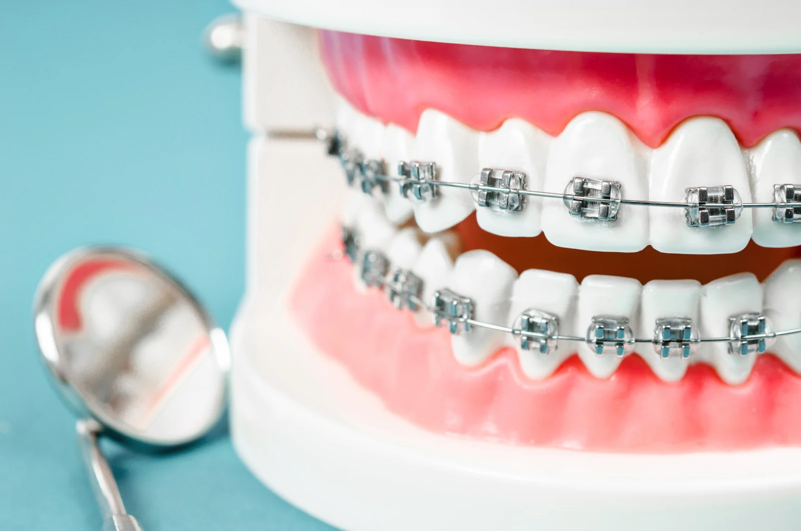 Orthodontic Braces: Before & After Transformations - MP Orthodontics