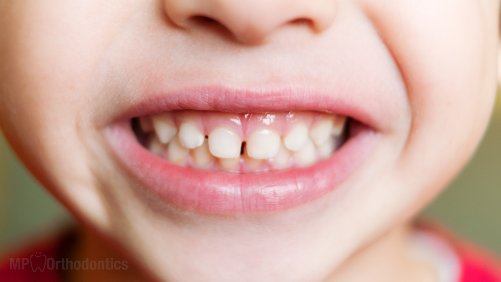 smile showing gaps in children's teeth